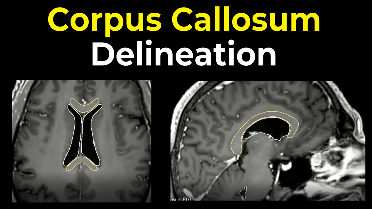 Corpus Callosum