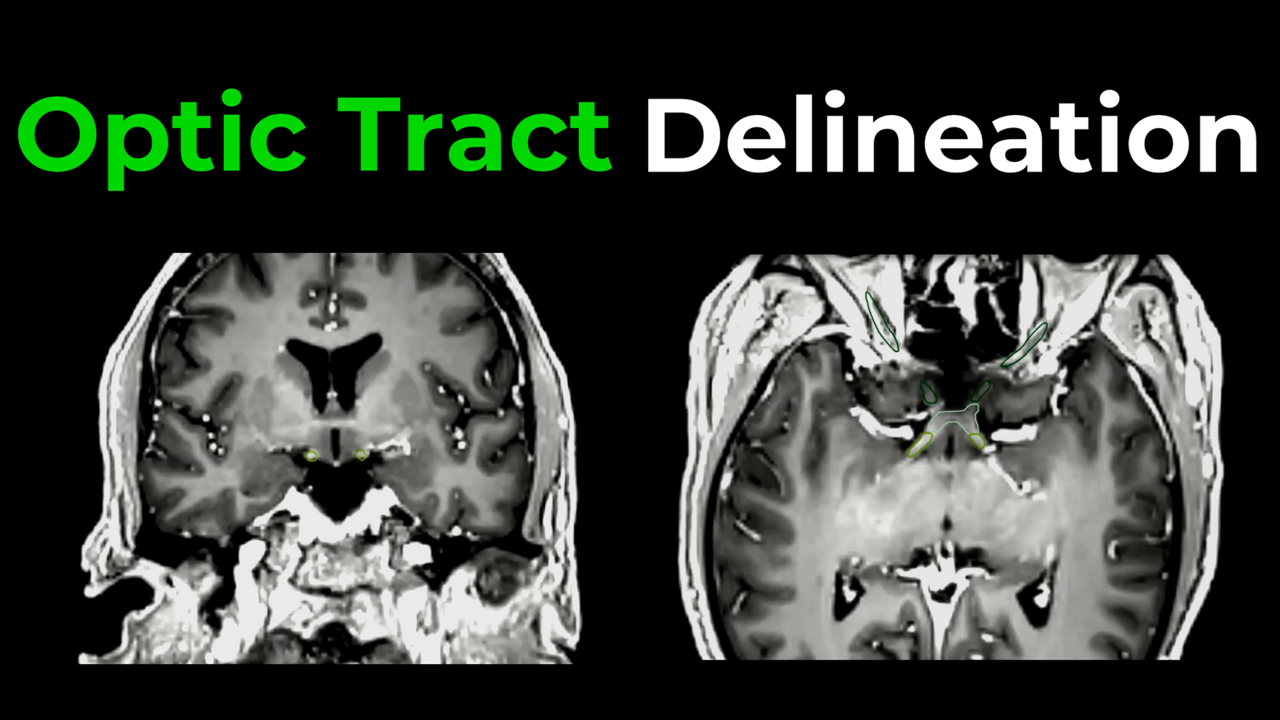 Optic Tract