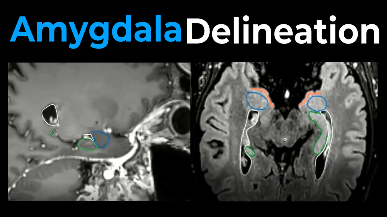 How to contour the Amygdala